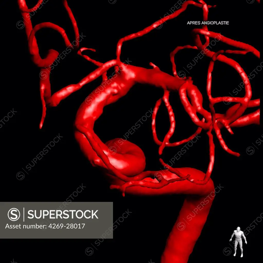 Angioplasty. Treatment of carotid stenosis by angioplasty and setting stent prosthesis. Here, 3D reconstruction arteries of a patient after treatment. Limoges hospital, France.