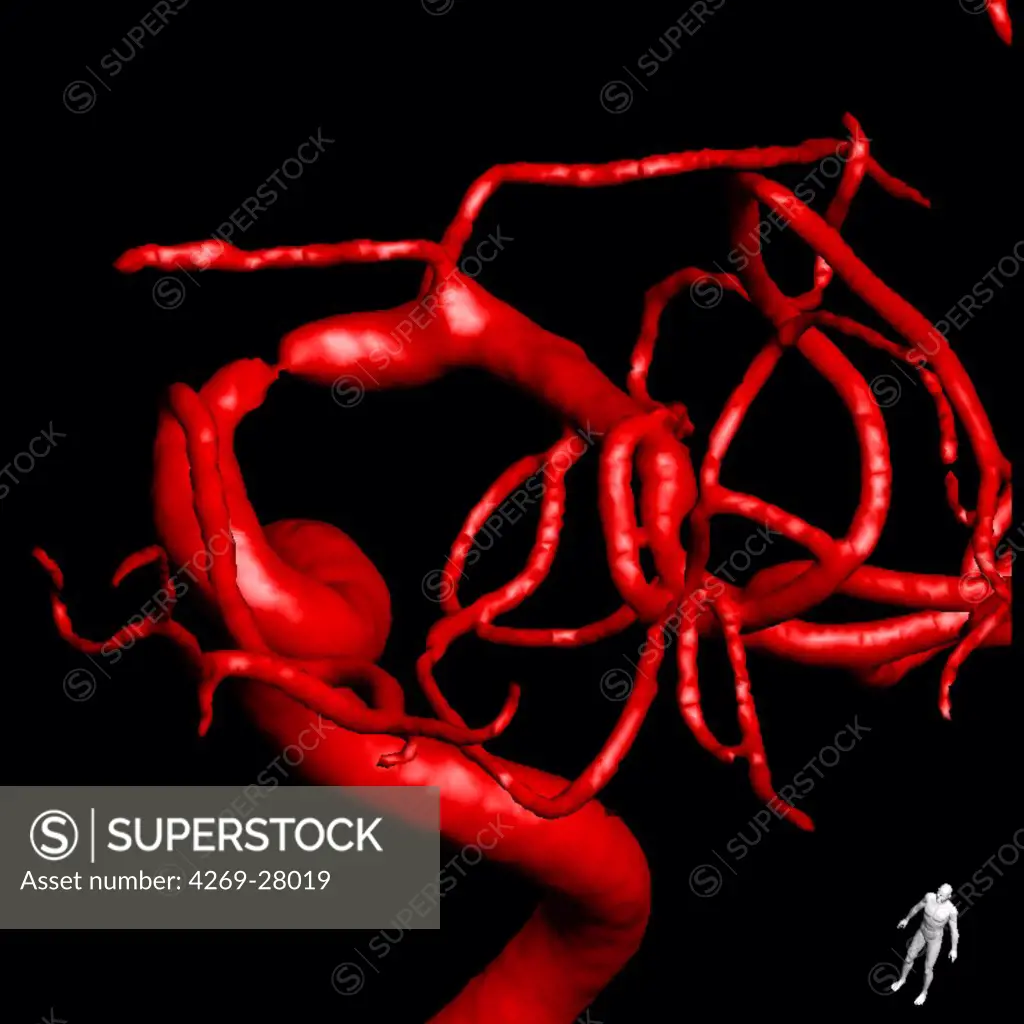 Angioplasty. Treatment of carotid stenosis by angioplasty and setting stent prosthesis. Here, 3D reconstruction arteries of a patient before treatment. Limoges hospital, France.