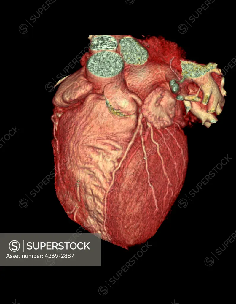 3D Computed Tomography (CT) reconstruction scan of a normal heart. The left coronary artery at center separated the right ventricle (at left) and the left ventricle (at right). Also seen the left and right atrium. Image obtained with a 64-Slice CT Scanner. Producing 64 slices per rotation, this advanced equipment is the first in France used only for heart diagnostic. The very high definition 3D images produced in less than 10 secondes are a usefull non invasive technique to observe a mobile orga