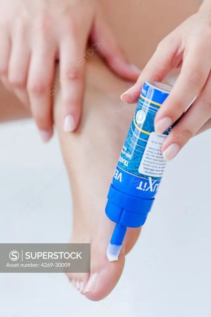 Wart treatment at home : woman applying an aerosol that provides a temperature of -50 degrees Celcius on cotton applicator, that 'freezes' the wart.