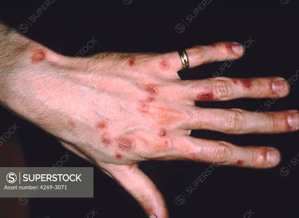 Skin lesions of erythema multiforme on the hand.