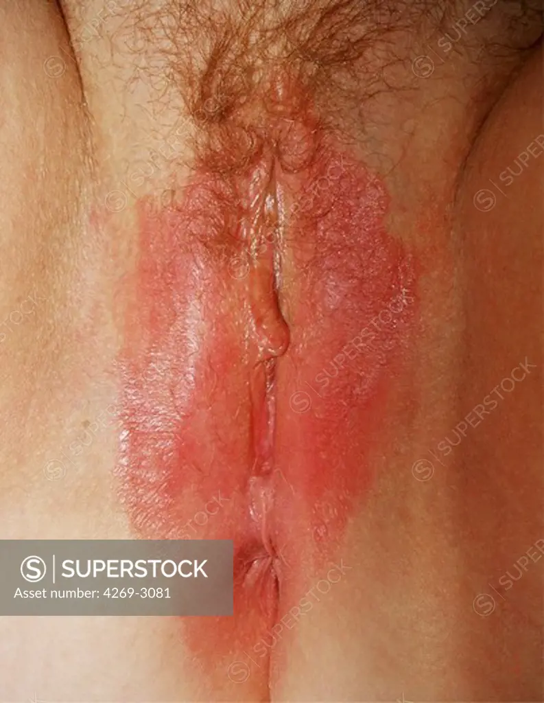 Inverse psoriasis on vulva.
