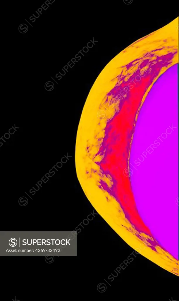 Coloured side view X-ray of a silicone implant inside a woman's breast.