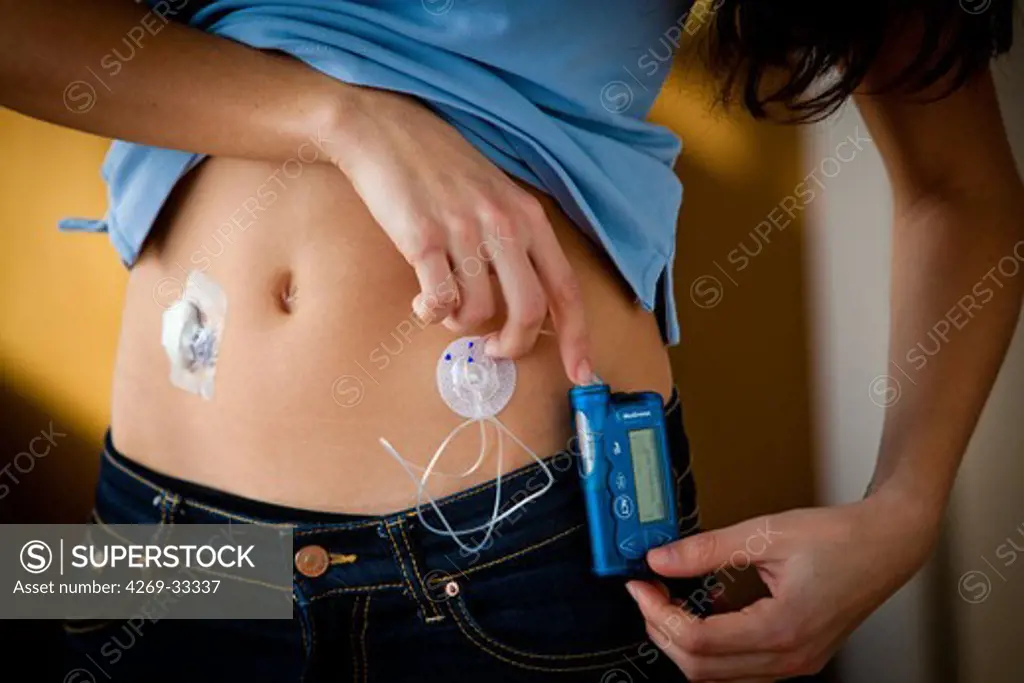 Programmable insulin pump administering insulin continuously through a catheter into the subcutaneous fat coupled to a glucose sensor.
