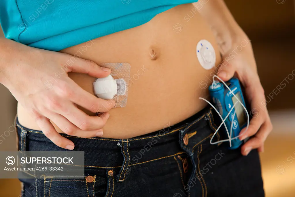 Programmable insulin pump administering insulin continuously through a catheter into the subcutaneous fat coupled to a glucose sensor.