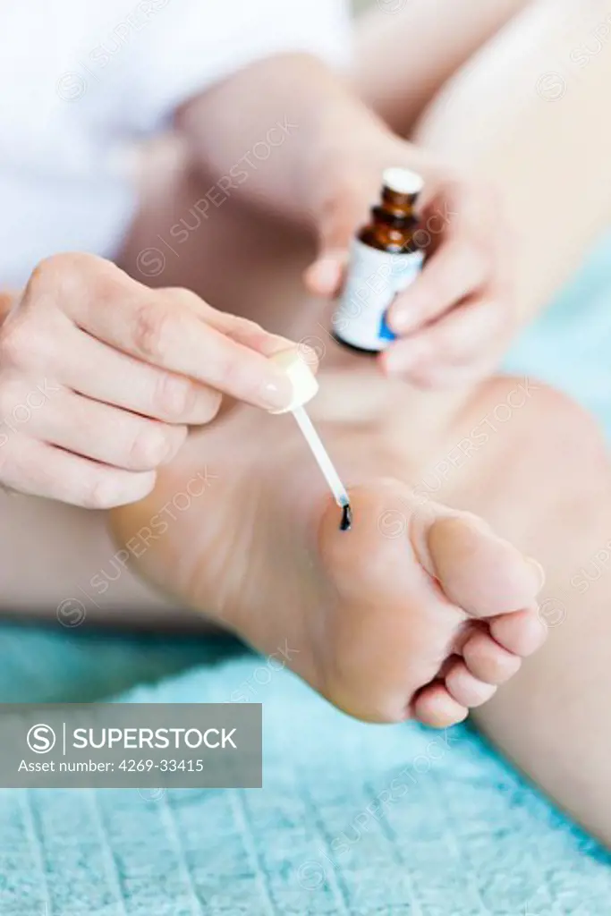 Woman using a treatment to remove wart on underfoot.