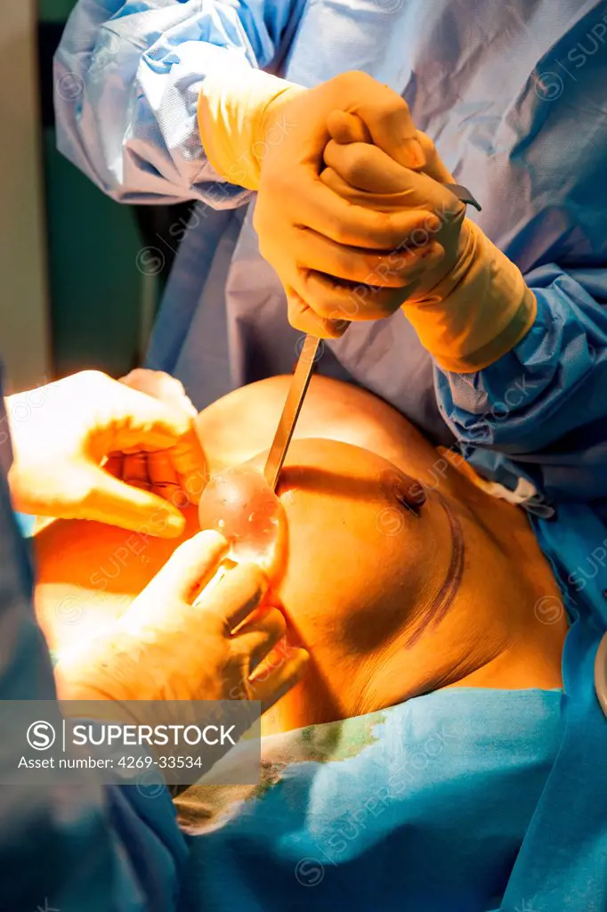 Placing of mammary prosthesis after explantation of Poly Implant Prothese PIP