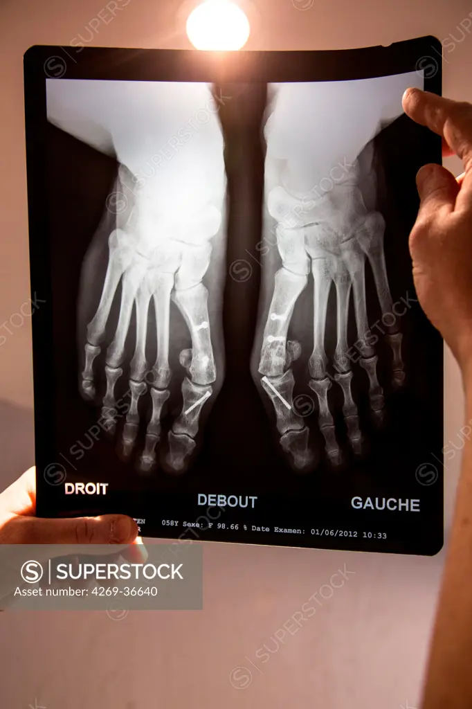 X-ray of feet affected by bunion (hallux valgus) after surgical treatment.