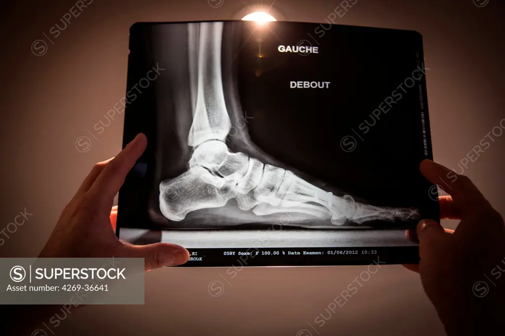 X-ray of a foot affected by bunion (hallux valgus) after surgical treatment.