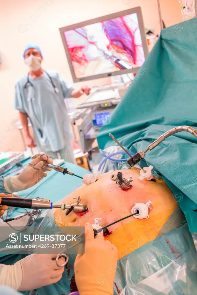 Surgeons performing a Laparoscopic Sleeve Gastrectomy, Limoges hospital.