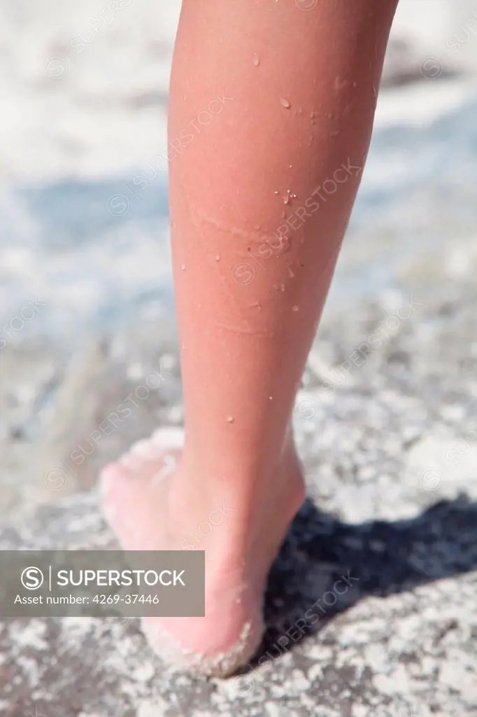 Jellyfish sting on a boy's skin.