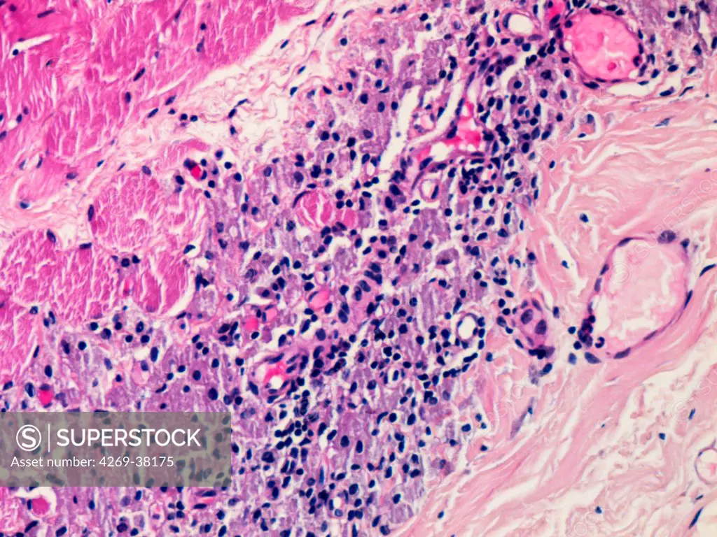 Light micrograph of a section through tissue from a deltoid muscle biopsy showing a macrophagic myofasciitis post-vaccination. The large cells contain clusters of colored particles in fuschia corresponding to aluminic adjuvant particles. Magnification unknown