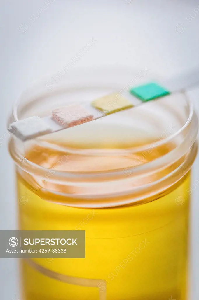 Urine sample with a test strip showing the results. This urine analysis is used to test for urinary tract infections.