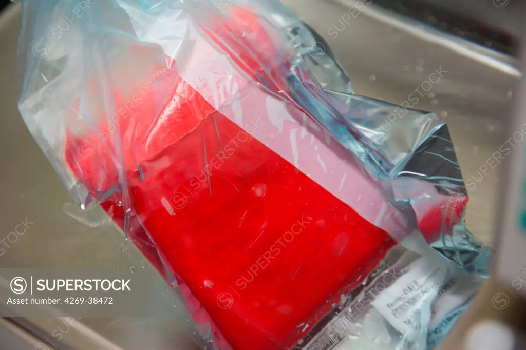 Hematopoietic stem cells bag during defrosting, prior to preparation, Cell Therapy Unit, CTSA in Clamart, France.