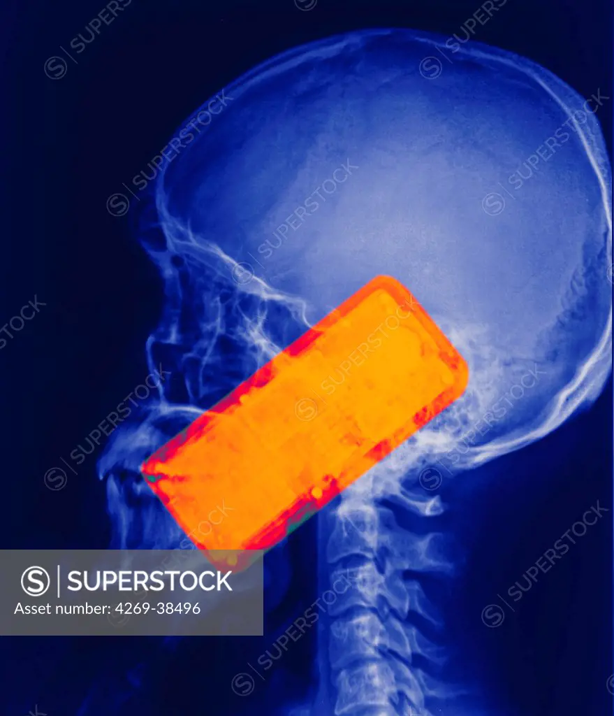 Colored X-ray showing the head of a man using a smartphone. The use of mobile phone generates microwaves that penetrate in the brain.