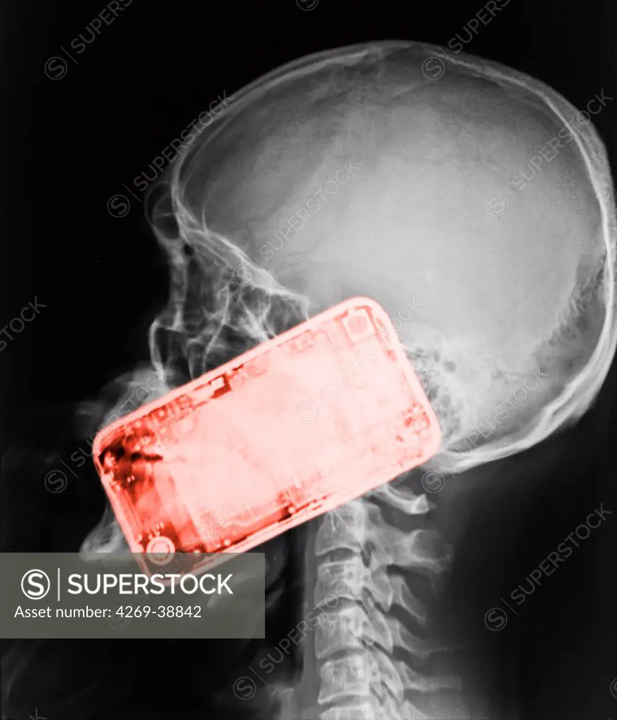 Colored X-ray showing the head of a man using a smartphone. The use of mobile phone generates microwaves that penetrate in the brain.