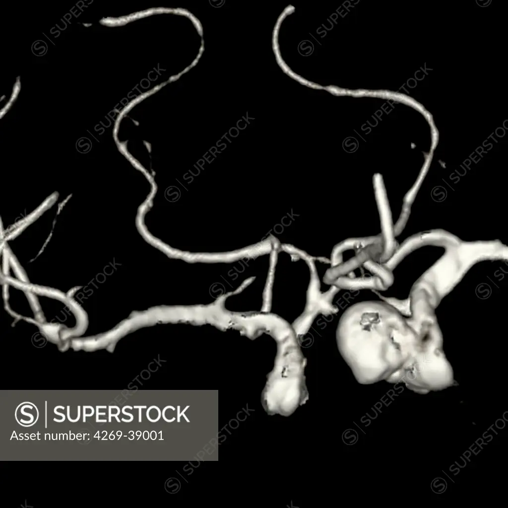 3D computed tomography (CT) scan of a pituitary adenoma by discovering multiple aneurysms.