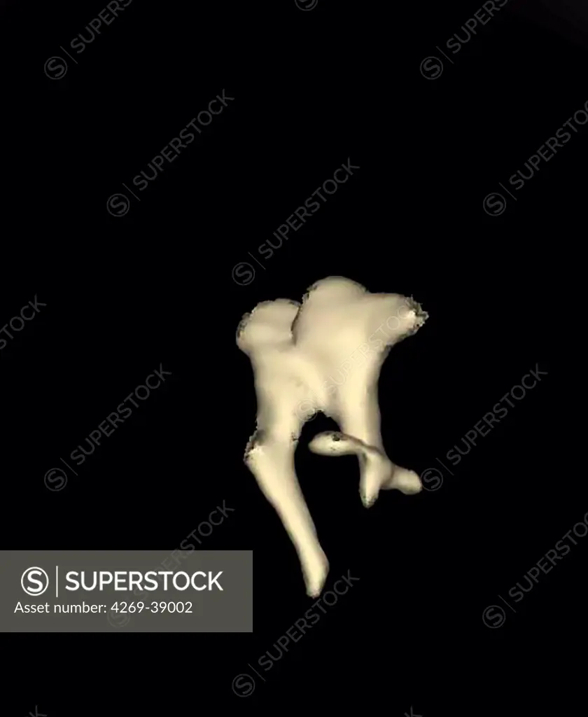 3D reconstruction of the inner ear showing three tiny bones (hammer, anvil, stirrup), computed tomography (CT) scan.