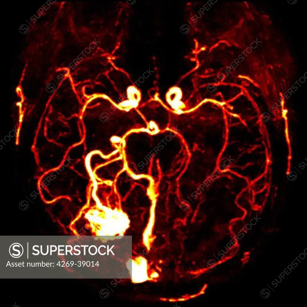 Cerebral arteriovenous malformation (AVM) in the occipital lobe (bottom left), CT-Angiography.