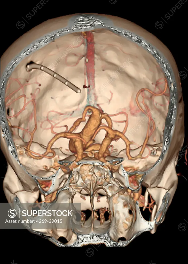 3D computed tomographic (CT) scan reconstruction of a skull showing an intracranial aneurysm (shaped swelling) located in the arterial circle of Willis (where the basilar artery and internal carotid arteries meet).