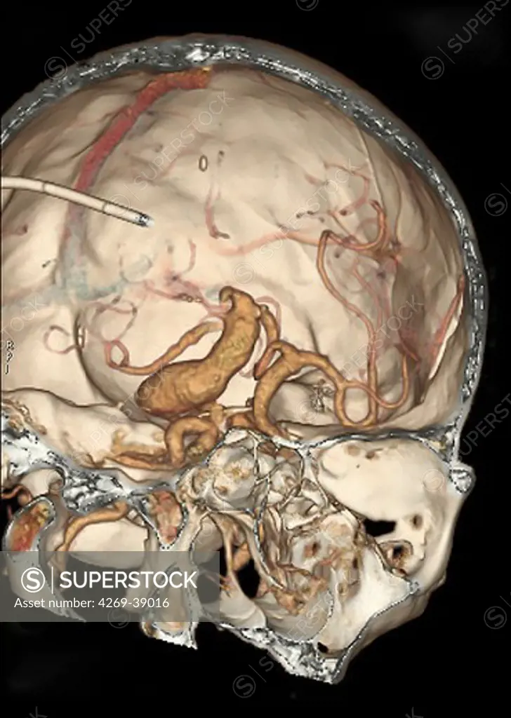 3D computed tomographic (CT) scan reconstruction of a skull showing an intracranial aneurysm (shaped swelling) located in the arterial circle of Willis (where the basilar artery and internal carotid arteries meet).