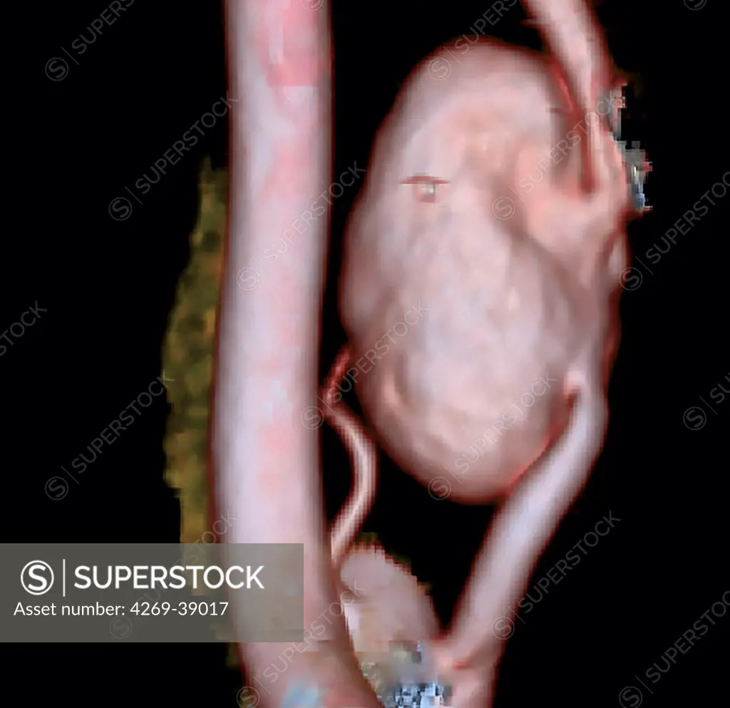 Vertebral artery aneurysm, 3D CT-Angiography.