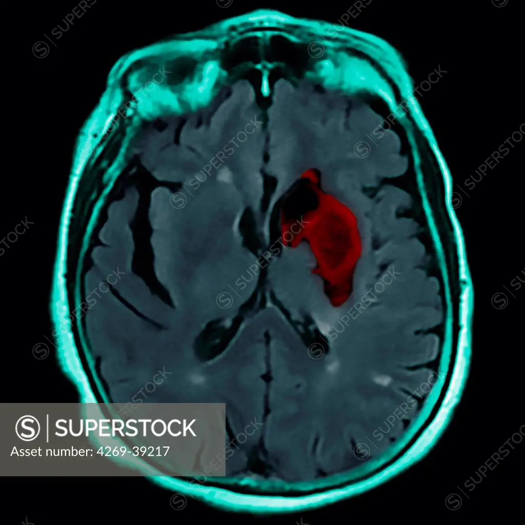 Coloured magnetic resonance imaging (MRI) scan and CT of an axial section through the brain of patient, showing the damage (red) caused 12 hours after a cerebral infarction.