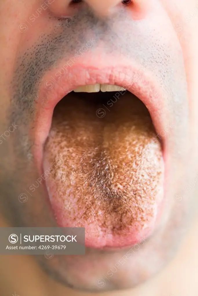 Close-up of black hairy tongue in an adult male patient caused by prolonged use of antibiotic drugs. The filiform papillae on the tongue have enlarged and become overgrown with fungi.