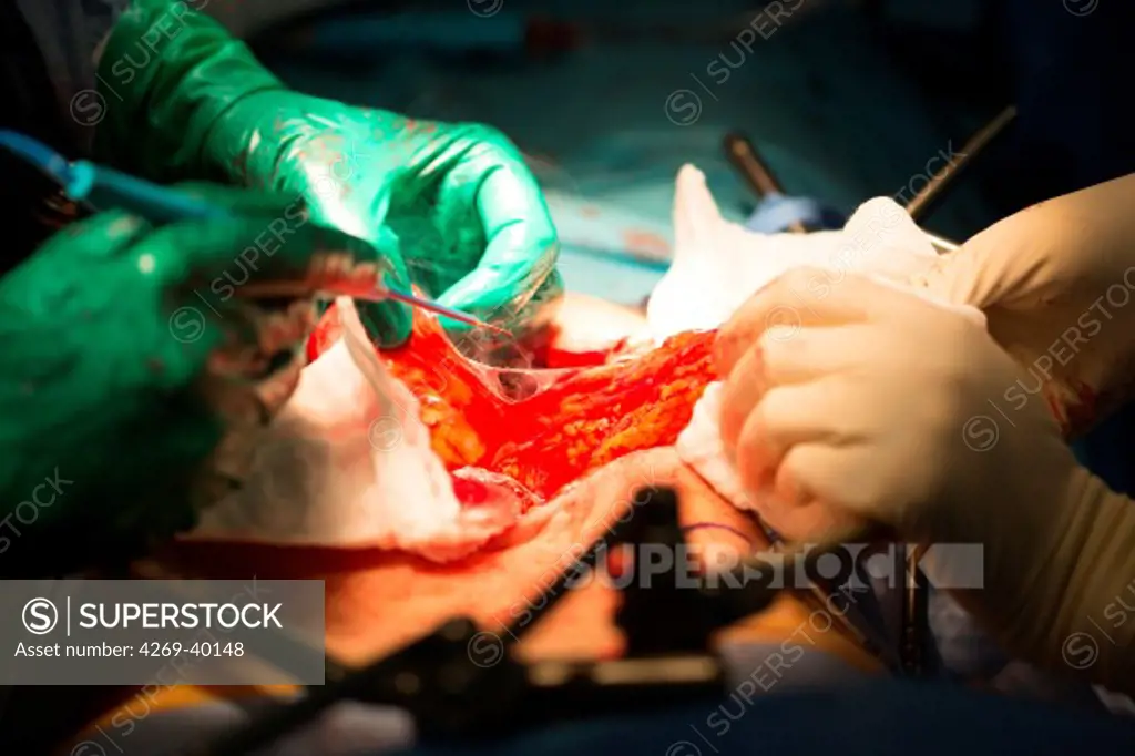 Surgical treatment of a bladder cancer by cystectomy, Bladder reconstruction by making a neo-bladder formed with a segment of intestine, Diaconesses hospital, Paris, France.