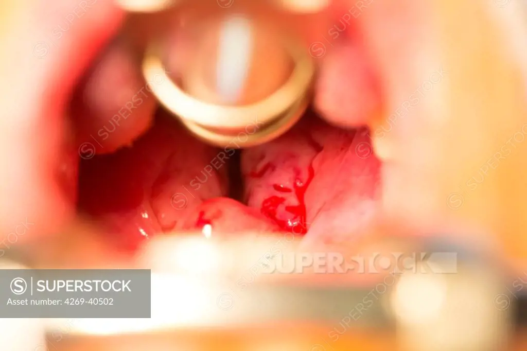 Treatment of snoring tonsillectomy (ablation of tonsils), Foch Hospital, Suresnes, France.