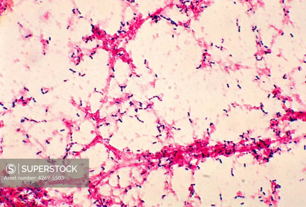 Photomicrograph of Streptococcus pneumoniae bacteria. This Gram-negative bacterium is a leading cause of pneumonia. It also causes many other pathologies like middle ear infections (otitis media), bacteremia and meningitis.