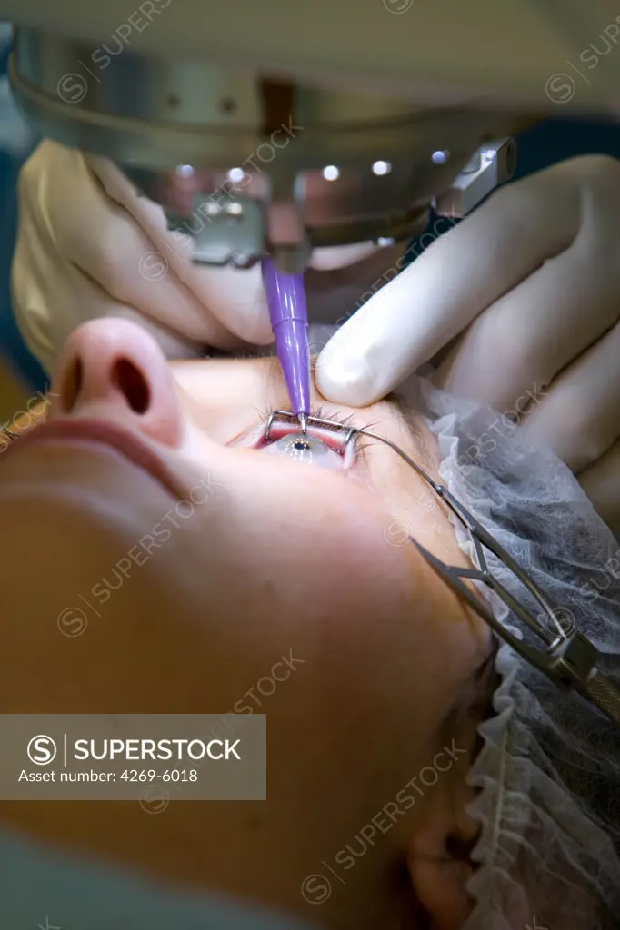 LASIK (Laser Assisted Intrastromal Keratomileusis). This surgery consists in creating a flap on the surface of the cornea with a femtosecond laser, and removing with an Excimer laser a micro-thin layer of corneal tissue beneath the flap, according to the anomaly to treat (myopia, hyperopia, astigmatism or presbyopia). The flap is then replaced. The new curve of the cornea allows a correct positioning of the image on the retina. Here, femtosecond laser beeing used.