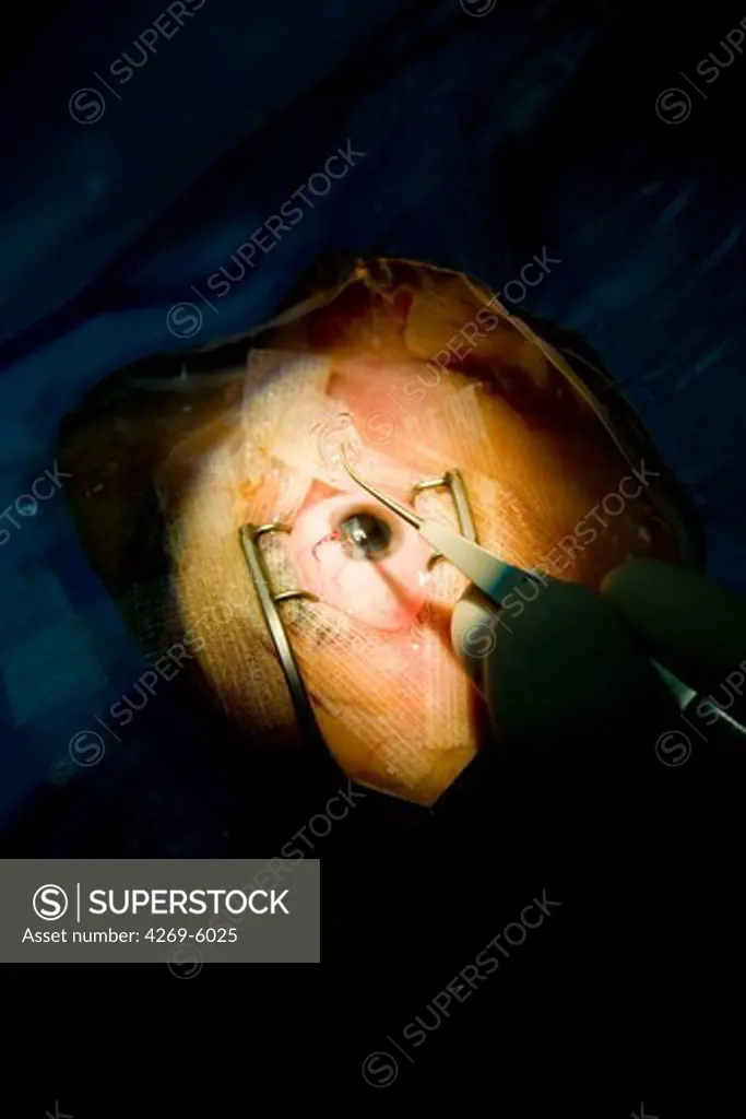 Cataract surgery. This eye surgery consists in replacing the lens of the eye with an artificial lens to restore visual acuity.