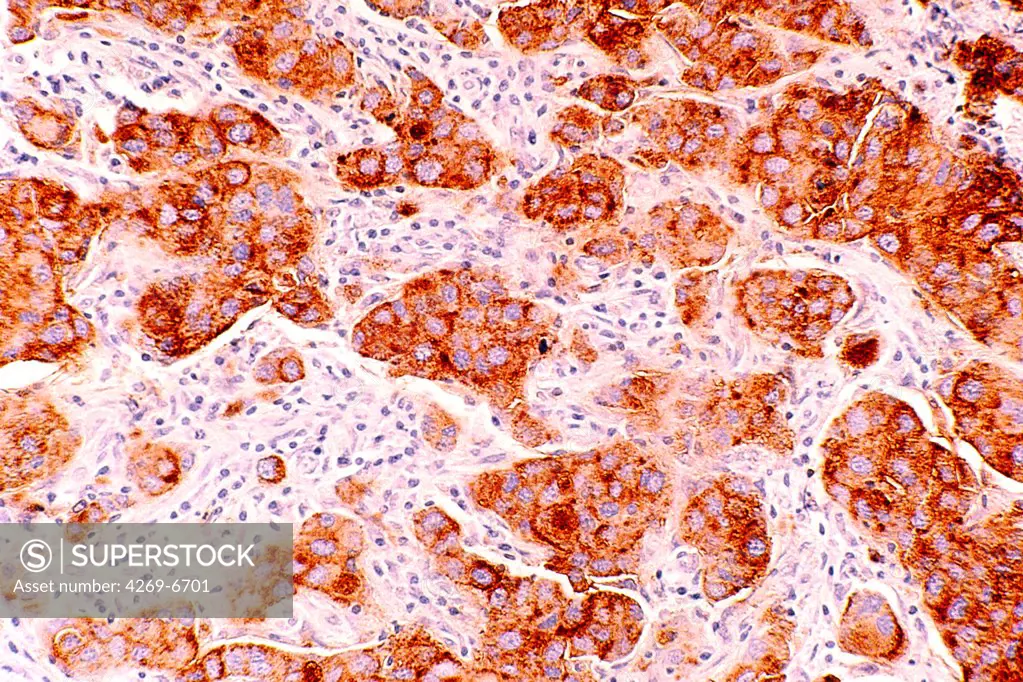 Photomicrograph of cancerous cells from ductal carcinoma of breast origin (brown) invading the breast tissue. Magnification is 313x.