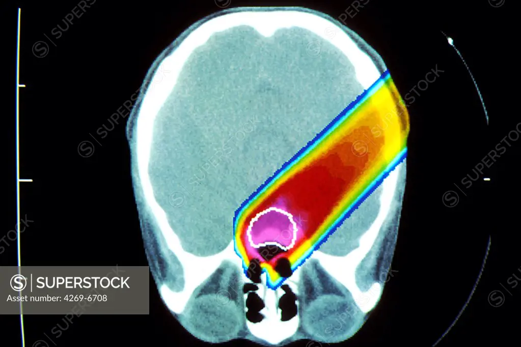 Image of a proton beam irradiating a brain tumor (circled in white).
