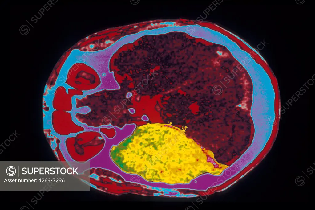 Coloured axial computed tomography (CT) scan of an adult's brain, showing encephalitis in the right temporal caused by an infection with herpes virus (encephalitis herpetica, in yellow). Encephalitis results in the inflammation of the encephalon.