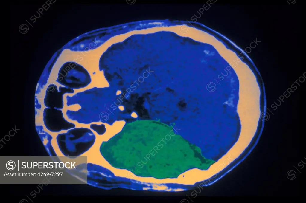 Coloured axial computed tomography (CT) scan of an adult's brain, showing encephalitis in the right temporal caused by an infection with herpes virus (encephalitis herpetica, in green). Encephalitis results in the inflammation of the encephalon.