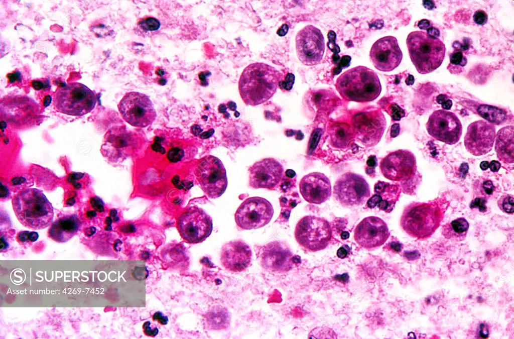 Brain tissue with amebic infection with Naegleria fowleri, a free-living amebae responsible for primary amebic meningoenceohalitis. Light micrograph.
