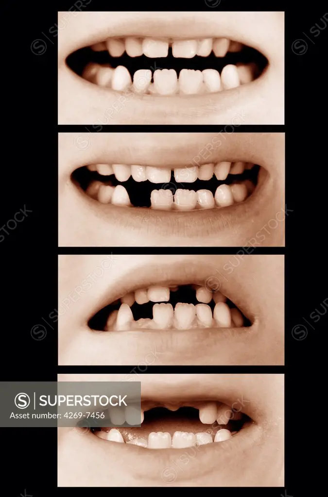 Milk teeth.