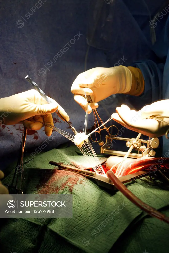 Mitral valve replacement surgery, an open heart surgery requiring a cardiopulmonary bypass. Thoracic and Cardiovascular Surgery Department, Limoges hospital, France.
