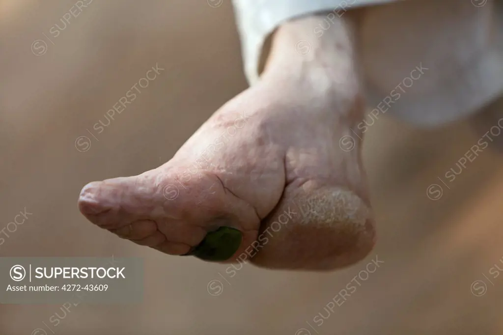 China, Yunnan, Liuyi. A bound foot with the broken toes forced underneath the foot, in the village of Liuyi.