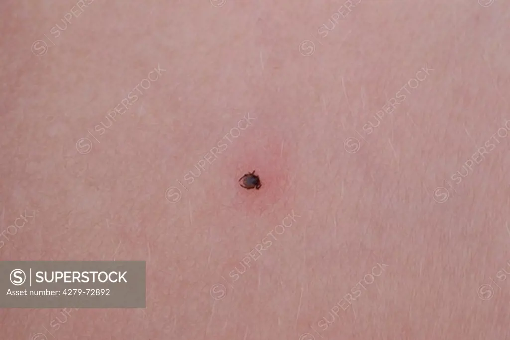 Castor Bean Tick (Ixodes ricinus) on human skin