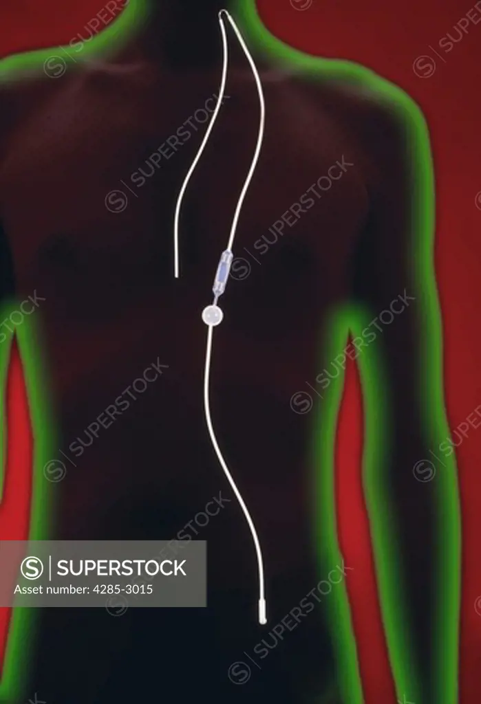 Computer generated image of the inside of a torso with a catheter running the length of the torso.