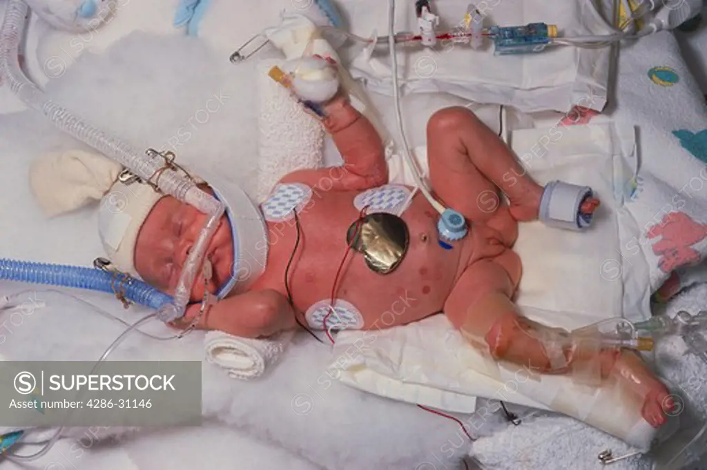 Premature newborn girl in hospital nursery attached to various medical equipment and monitors.
