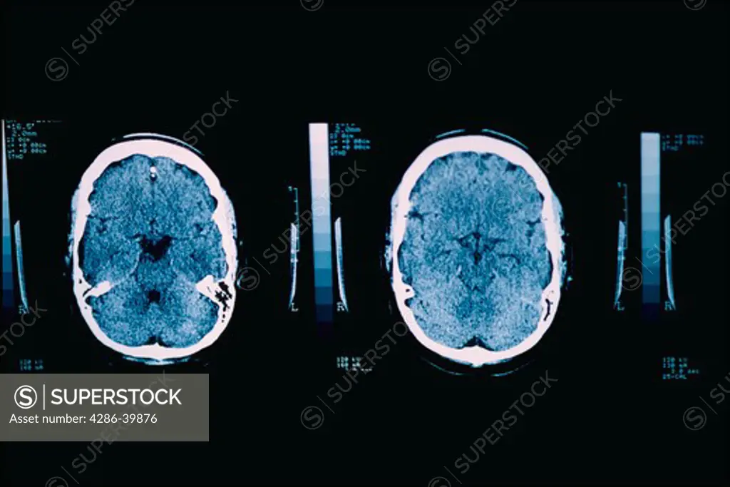 CT scans of a human brain.