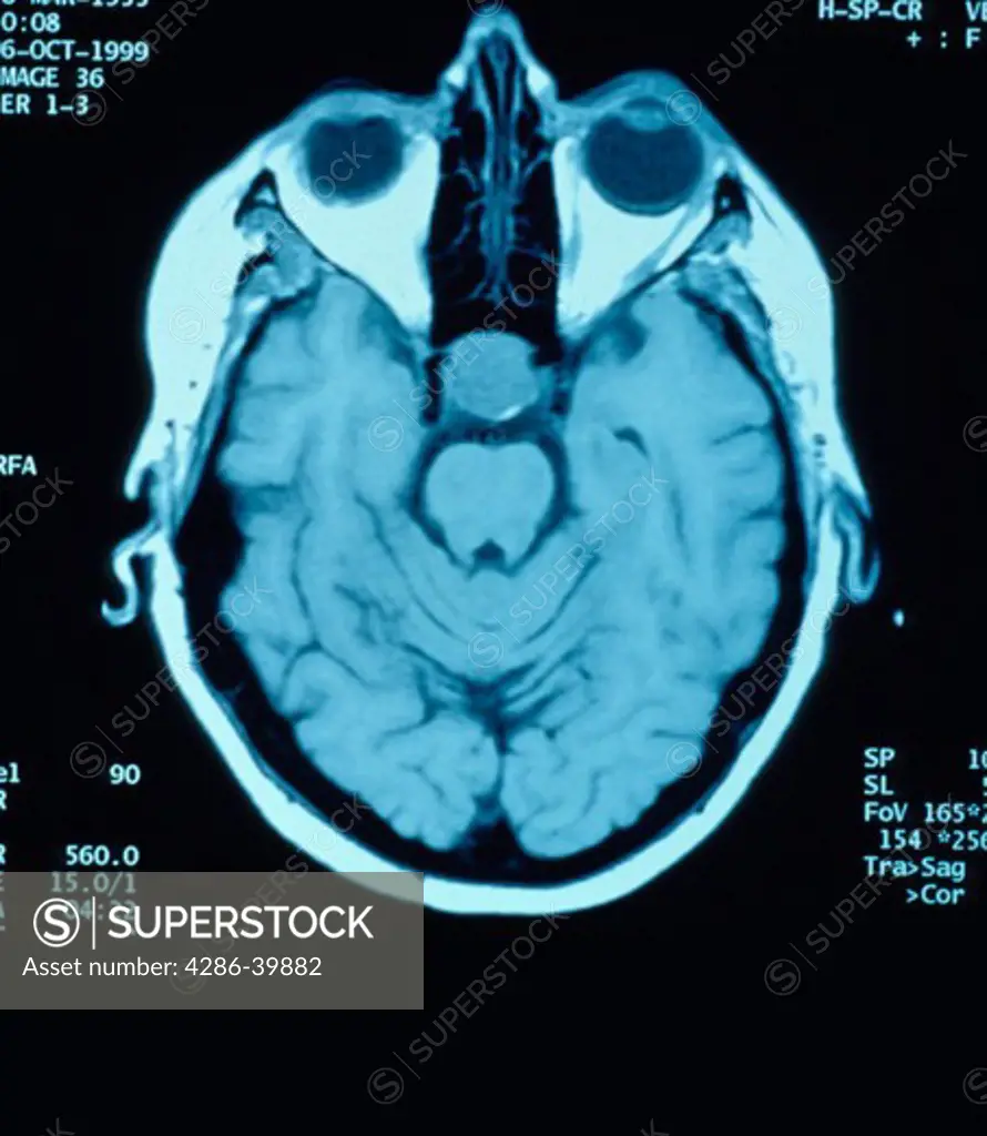 CT scan showing a cross section of a human head.