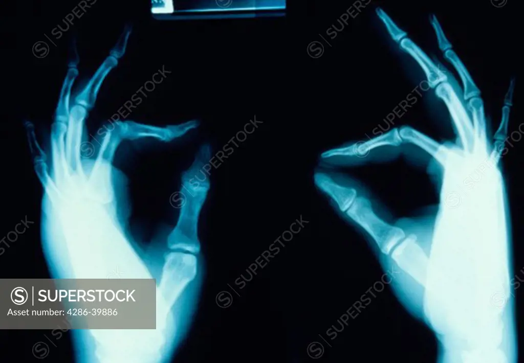 X-ray of two human hands with thumb and pointer fingers touching.