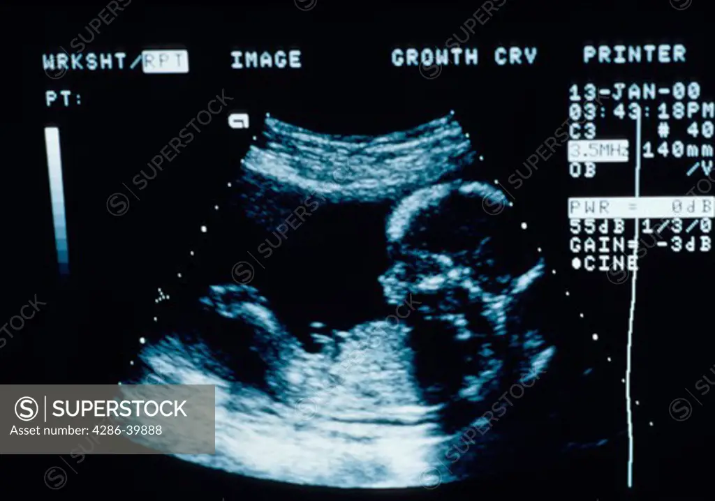 A sonogram image of a fetus in a womans womb.