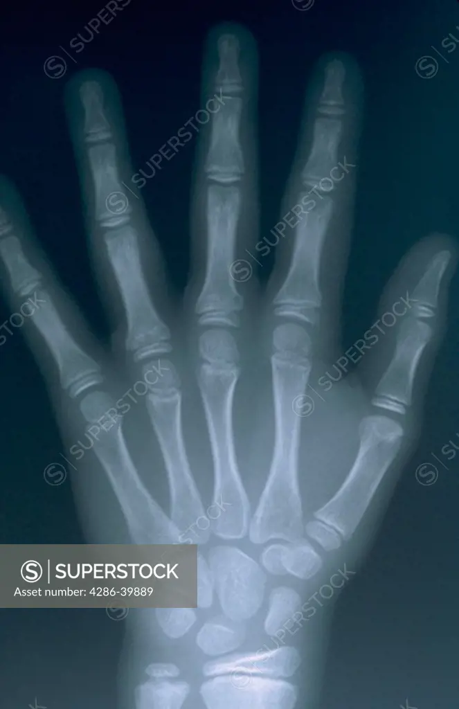 X-ray of a human hand lying flat with fingers extended.