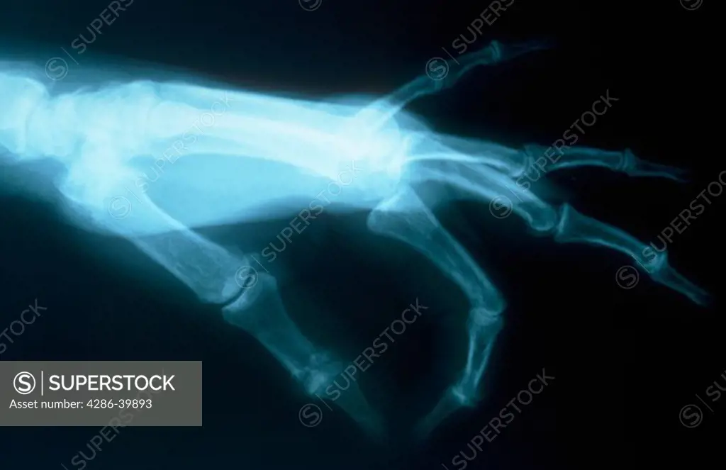 X-ray of a human hand with thumb and pointer finger touching.